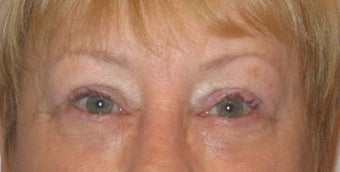 Upper and lower lid blepharoplasty, ptosis repair, chemical peel to lower lids after 875953