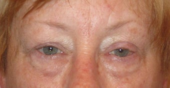 Upper and lower lid blepharoplasty, ptosis repair, chemical peel to lower lids before 875953