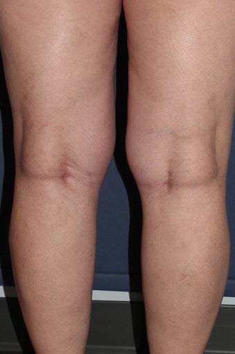 62 year old female treated with Sclerotherapy for Leg Veins after 986681