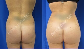 Buttock augmentation before 874647
