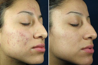 Chemical Peel before 402124