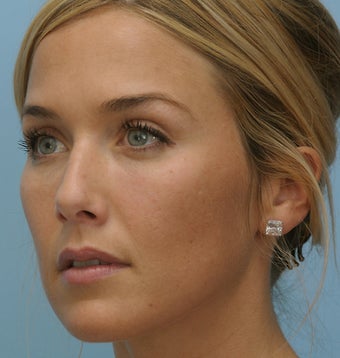 Cheek Dermafiller, Under Eye Dermafiller after 208581