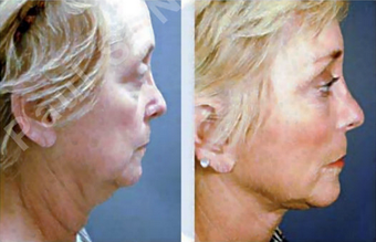 Complete Facial Rejuvenation after 138171