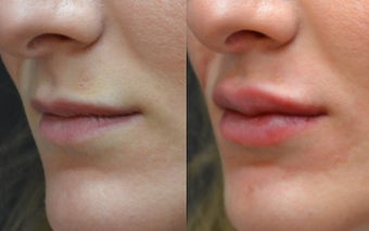 Restylane Filler to Lips before 1306469