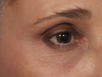 Thermage CPT to Eyes 308323