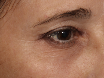 Thermage CPT to Eyes 308323