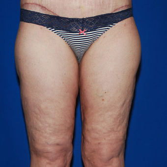 Thigh Lift after 945348