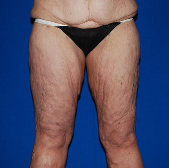 Thigh Lift before 945348