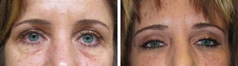 Juvederm/Fat Grafting before 718218