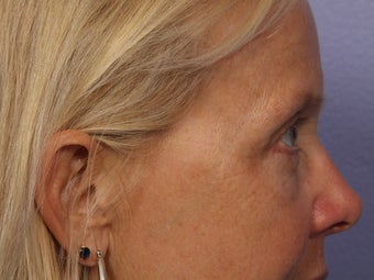 Eyelid Surgery after 280871