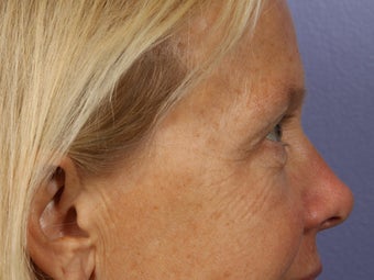 Eyelid Surgery before 280871