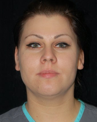 Cheek Fat Pad Removal before 902790