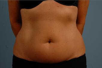 TruSculpt 758725