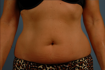 TruSculpt 758725