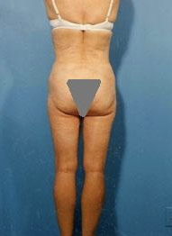Buttocks Enhancement after 296683