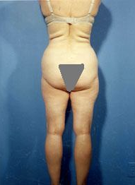 Buttocks Enhancement before 296683