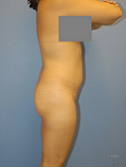 Buttocks Enhancement 296683