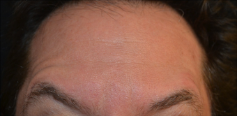 45 Year Old Male Treated for Forehead Lines after 1367245