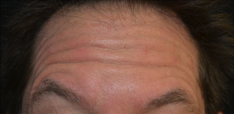 45 Year Old Male Treated for Forehead Lines before 1367245