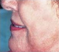 Skin Tightening after 208856