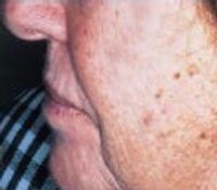 Skin Tightening before 208856