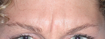Botox for Glabella "11's" before 1376631