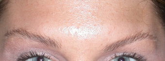 Botox for Glabella "11's" after 1376631