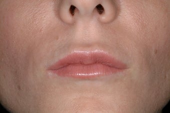 Juvederm Ultra after 86810