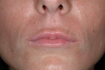 Juvederm Ultra before 86810