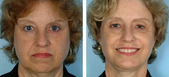 Facelift before 1205000