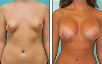 Breast Reconstruction before 1115968