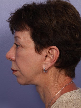 Eyelid Surgery after 280833