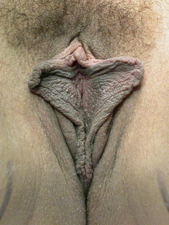 Labiaplasty before 281453