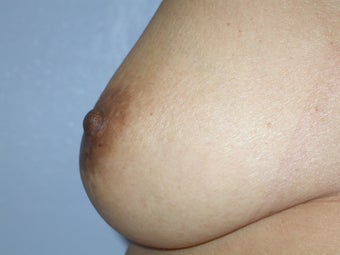 Nipple Reduction after 117552