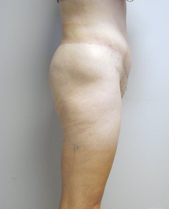 Before and After Lower Body Lift (Lateral View) after 66053