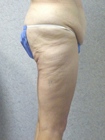 Before and After Lower Body Lift (Lateral View) before 66053