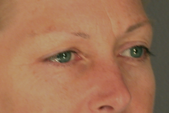 Eyelid Surgery before 310160