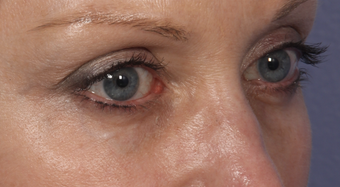 Eyelid Surgery after 310160