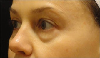Restylane before 686377