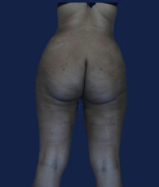 liposuction after 476630