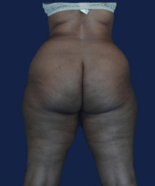 liposuction before 476630
