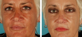 Forehead Lift before 1208023
