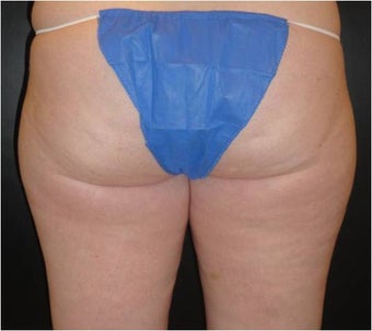 SmartLipo MPX before 686151