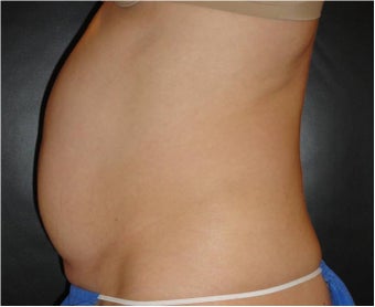 SmartLipo MPX before 686308