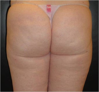 SmartLipo MPX after 686151