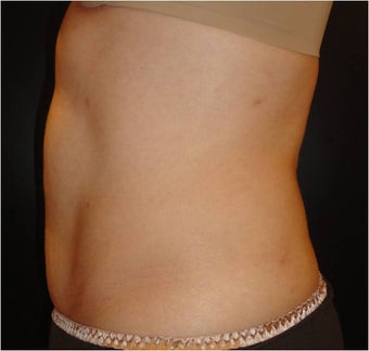 SmartLipo MPX after 686308