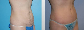 Tummy Tuck (Abdominoplasty) before 258056