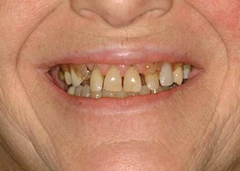Full Mouth Reconstruction before 714448