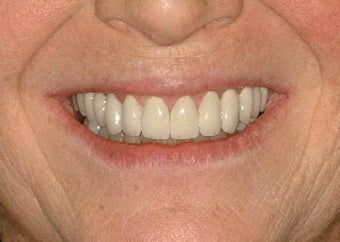 Full Mouth Reconstruction after 714448