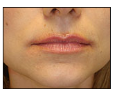 Injectables before 722760